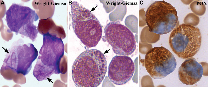 Acute promyelocytic leukemia (APL): Wright-Giemsa and MPO staining of promyeloblasts with Auer rods (arrows). The myelocyte's antecedent stage, arrested in APL.
