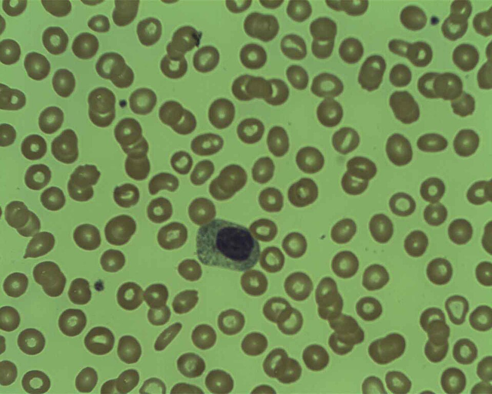 Myelocyte on bone marrow preparation, Giemsa stain. Normal morphology: round nucleus, pale cytoplasm.